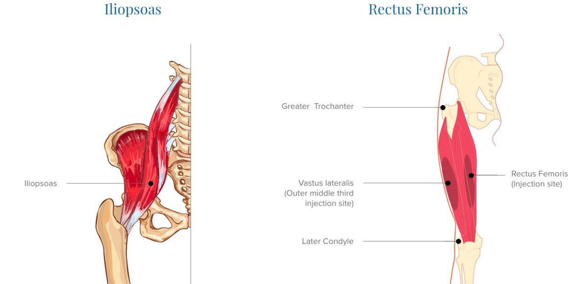 Common Hip Flexor Injuries And Treatments When Walking The Shoe Box Nyc