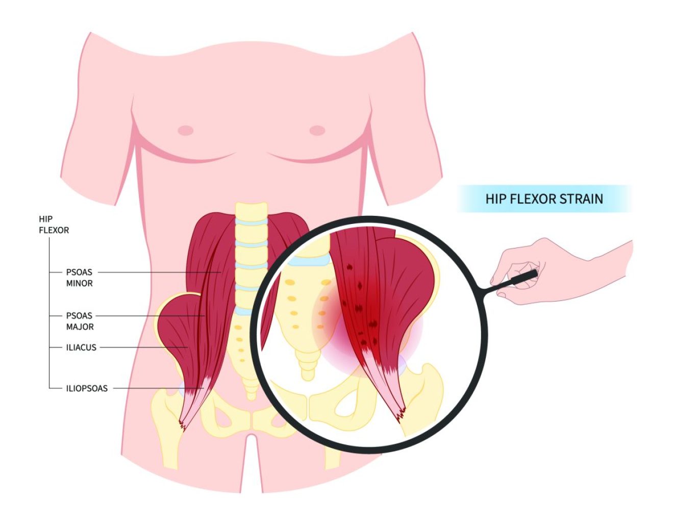 Common Hip Flexor Injuries And Treatments When Walking The Shoe Box Nyc